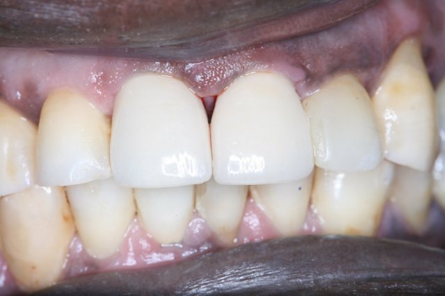 Crowns After